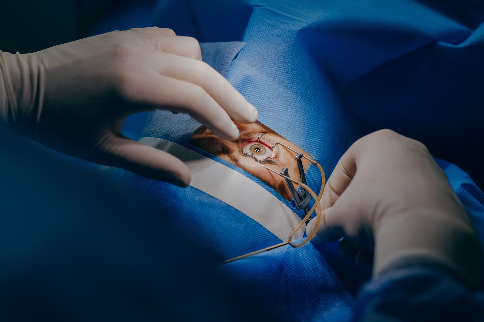 Médico realiza cirurgia oftalmológica para catarata